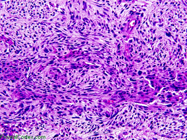 Gliosarcoma (glioblastoma multiforme with prominent spindle cell differentiation), H&E stain x200